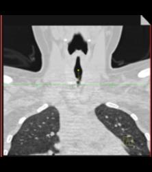 Tracheal Stenosis Due to Prior Intubation - CTisus CT Scan