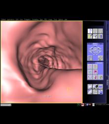 Tracheal Stenosis Due to Prior Intubation - CTisus CT Scan