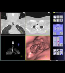 Tracheal Stenosis Due to Prior Intubation - CTisus CT Scan