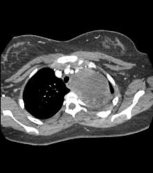 Neurogenic Sarcoma in Upper Mediastinum- See Full Sequence - CTisus CT Scan