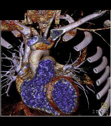 Neurogenic Sarcoma in Upper Mediastinum- See Full Sequence - CTisus CT Scan