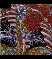 Neurogenic Sarcoma in Upper Mediastinum- See Full Sequence - CTisus CT Scan