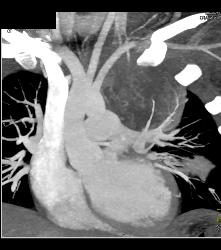 Neurogenic Sarcoma in Upper Mediastinum- See Full Sequence - CTisus CT Scan