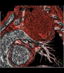 Neurogenic Sarcoma in Upper Mediastinum- See Full Sequence - CTisus CT Scan