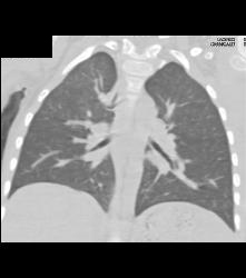 Right Tracheal Bronchus and Tracheal Stenosis in Trachea Below Right Tracheal Bronchus- See Full Sequence - CTisus CT Scan