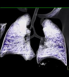 Right Tracheal Bronchus and Tracheal Stenosis in Trachea Below Right Tracheal Bronchus- See Full Sequence - CTisus CT Scan