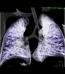 Right Tracheal Bronchus and Tracheal Stenosis in Trachea Below Right Tracheal Bronchus- See Full Sequence - CTisus CT Scan