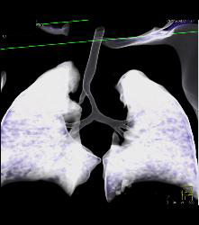 Right Tracheal Bronchus and Tracheal Stenosis in Trachea Below Right Tracheal Bronchus- See Full Sequence - CTisus CT Scan