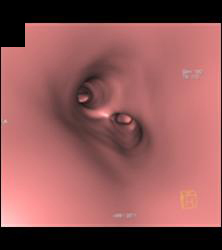 Right Tracheal Bronchus and Tracheal Stenosis in Trachea Below Right Tracheal Bronchus- See Full Sequence - CTisus CT Scan