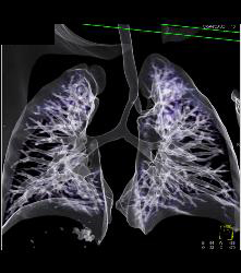 Right Tracheal Bronchus and Tracheal Stenosis in Trachea Below Right Tracheal Bronchus- See Full Sequence - CTisus CT Scan