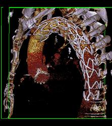 Stent in Aortic Arch - CTisus CT Scan