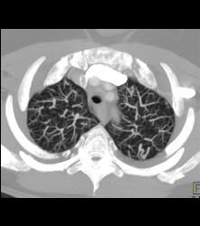 Pulmonary Arteriovenous Malformations (PAVMs) Bilaterally - CTisus CT Scan