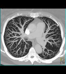 Pulmonary Arteriovenous Malformations (PAVMs) Bilaterally - CTisus CT Scan