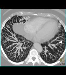 Pulmonary Arteriovenous Malformations (PAVMs) Bilaterally - CTisus CT Scan