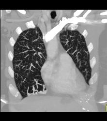 Pulmonary Arteriovenous Malformations (PAVMs) Bilaterally - CTisus CT Scan