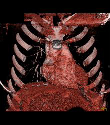 Pulmonary Arteriovenous Malformations (PAVMs) Bilaterally - CTisus CT Scan