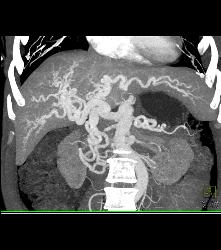 Hereditary Hemorrhagic Telangiectasia (HHT) With Hepatic Arteriovenous Malformations (AVMs) - CTisus CT Scan