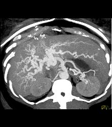 Hereditary Hemorrhagic Telangiectasia (HHT) With Hepatic Arteriovenous Malformations (AVMs) - CTisus CT Scan