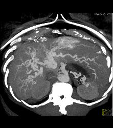 Hereditary Hemorrhagic Telangiectasia (HHT) With Hepatic Arteriovenous Malformations (AVMs) - CTisus CT Scan