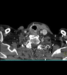 Recurrent Tracheal Tumor With Right Supraclavicular Nodes - CTisus CT Scan