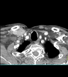 Recurrent Tracheal Tumor With Right Supraclavicular Nodes - CTisus CT Scan