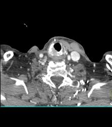 Recurrent Tracheal Tumor With Right Supraclavicular Nodes - CTisus CT Scan