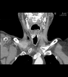 Recurrent Tracheal Tumor With Right Supraclavicular Nodes - CTisus CT Scan