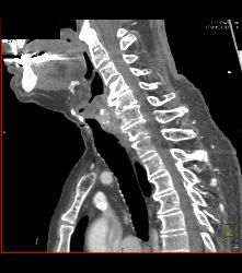 Recurrent Tracheal Tumor With Right Supraclavicular Nodes - CTisus CT Scan