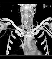 Asymmetric Jugular Veins - CTisus CT Scan