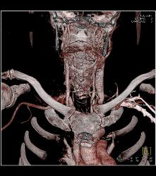 Asymmetric Jugular Veins - CTisus CT Scan