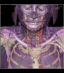 Asymmetric Jugular Veins - CTisus CT Scan