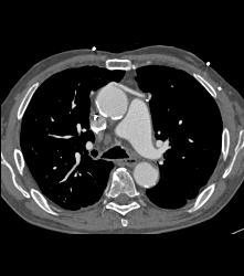 Bronchiectasis and Infection in Patient With Coronary Artery Bypass Graft (CABG) - CTisus CT Scan