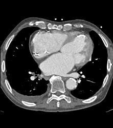 Prior Myocardial Infarct - CTisus CT Scan