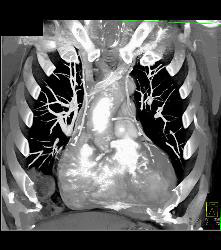 Prior Myocardial Infarct - CTisus CT Scan