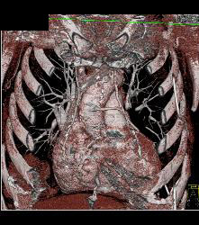 Prior Myocardial Infarct - CTisus CT Scan