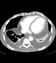 Pericardial Effusion - CTisus CT Scan