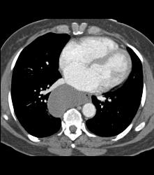 Bronchogenic Cyst - CTisus CT Scan