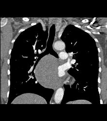 Bronchogenic Cyst - CTisus CT Scan