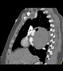 Bronchogenic Cyst - CTisus CT Scan