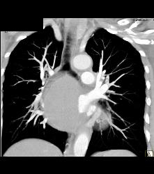 Bronchogenic Cyst - CTisus CT Scan