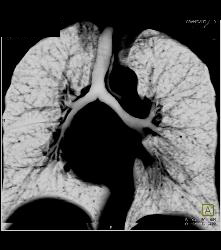 Bronchogenic Cyst - CTisus CT Scan