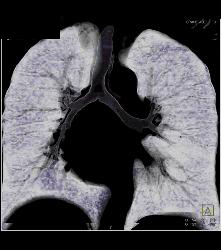 Bronchogenic Cyst - CTisus CT Scan