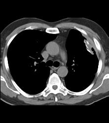 Rounded Atelectasis - CTisus CT Scan