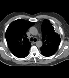 Rounded Atelectasis - CTisus CT Scan