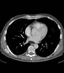 Pulmonary Artery Pseudoaneurysm in A Drug Addict. Note Pulmonary Hemorrhage as Well - CTisus CT Scan