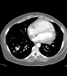 Pulmonary Artery Pseudoaneurysm in A Drug Addict. Note Pulmonary Hemorrhage as Well - CTisus CT Scan