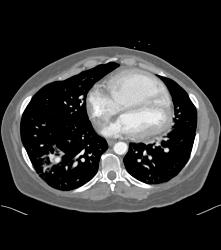 Pulmonary Artery Pseudoaneurysm in A Drug Addict. Note Pulmonary Hemorrhage as Well - CTisus CT Scan