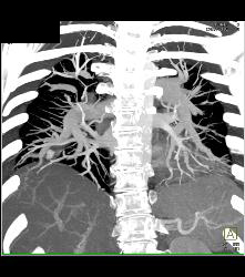 Pulmonary Artery Pseudoaneurysm in A Drug Addict. Note Pulmonary Hemorrhage as Well - CTisus CT Scan