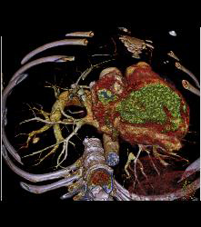 Pulmonary Artery Pseudoaneurysm in A Drug Addict. Note Pulmonary Hemorrhage as Well - CTisus CT Scan