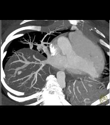 Pulmonary Artery Pseudoaneurysm in A Drug Addict. Note Pulmonary Hemorrhage as Well - CTisus CT Scan